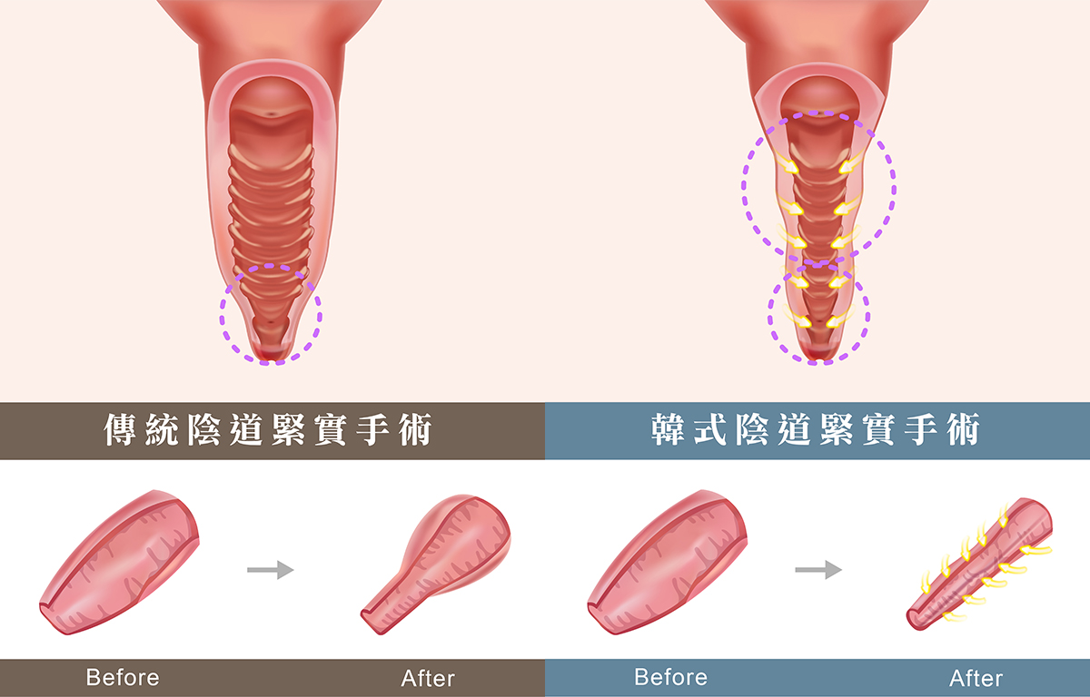 傳統陰道手術與韓式陰道手術的差別
