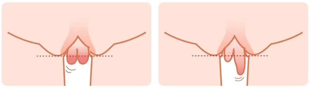 小陰唇過長該如何判斷?